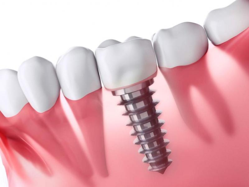 Цена имплантации зубов