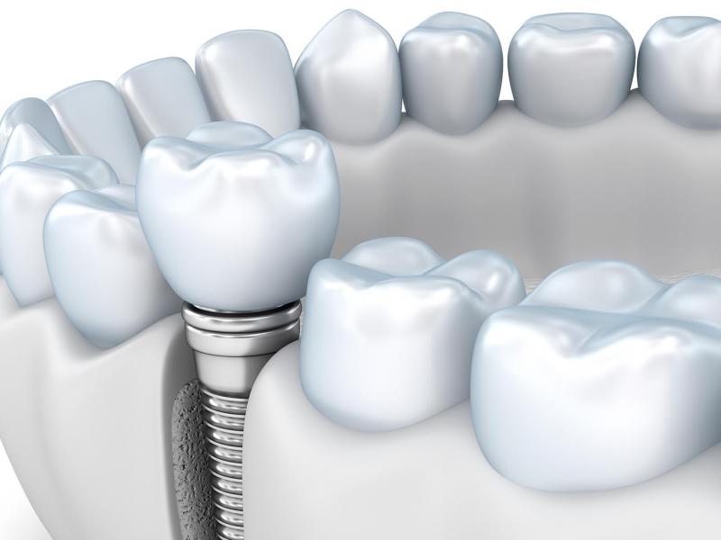 Цена имплантации зубов